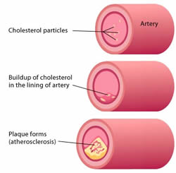 Arterial Cholesterol