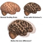 Alzheimer\'s Disease